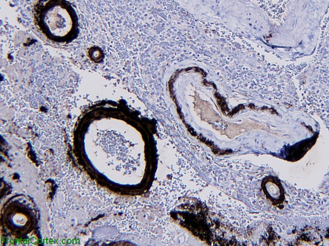 Amyloid Angiopathy, immunohistochemical staining for beta amyloid